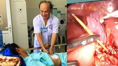 Bị đâm xuyên lách vì ngậm tăm đi ngủ