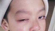 Lạng Sơn: Học sinh có nguy cơ bị mù vì bị giáo viên đánh, công an vào cuộc điều tra