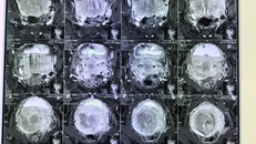 Tầm soát sớm ung thư cổ tử cung như thế nào?