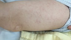 Vết ban đỏ trên người bệnh nhân. Ảnh: BVCC.
