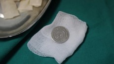 Chiếc đồng xu hình tròn mà bé trai 5 tuổi nuốt vào cổ họng.