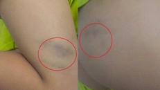 Phần chân và mông bị bầm tím của cháu T. Ảnh: Gia đình cung cấp.