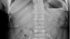 Nhập viện vì sán lá gan sinh sôi khắp cơ thể