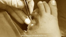 Ngón chân đứt rời sau tai nạn - Ảnh: Bệnh viện cung cấp