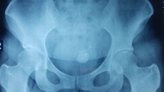 Một phần vòng tránh thai "hóa sỏi" cản quang trên hình ảnh kiểm tra