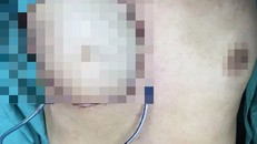 Hoại tử một bên ngực do đắp lá chữa ung thư vú