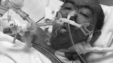 Khắp người bệnh nhân chằng chịt nốt hồng ban trong ngày đầu nhập viện. Ảnh: Minh Tâm.