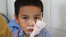 Bé trai 5 tuổi nhập viện vì bị chó cắn rách mặt