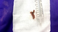 Hóc xương cá 3 tháng, người đàn ông nhiễm trùng phế quản nặng