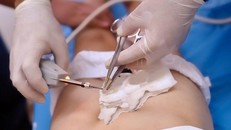 Nam thanh niên bị cần cẩu công trình móc rách tinh hoàn