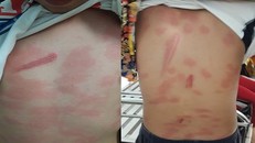 Xác minh vụ bé trai 13 tuổi ở Tiền Giang bị cô ruột bạo hành dã man