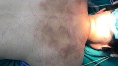 Cổ gáy bệnh nhân bầm tím do đi giác hơi - Ảnh: Tiền phong