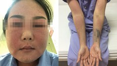 Cô gái trẻ bị sưng nề, da bong tróc sau khi bôi kem làm trắng