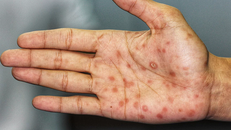 Bé trai 13 tuổi mắc bệnh giang mai vì bị lạm dụng tình dục