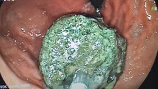 Hình ảnh siêu âm dạ dày của bệnh nhân