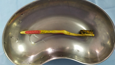 Chiếc bàn chải được gắp ra khỏi tá tràng bệnh nhân. Ảnh: Vnexpress