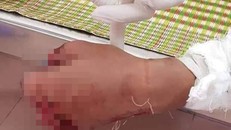 Quảng Trị: Vừa chơi game vừa sạc điện thoại, nam thanh niên bị bỏng nặng