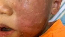 Đeo mặt nạ hóa trang Halloween, bé trai 4 tuổi bị phồng rộp da mặt