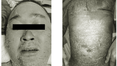 Người đàn ông bị mụn mủ toàn thân do chữa vảy nến bằng cách đắp thuốc nam