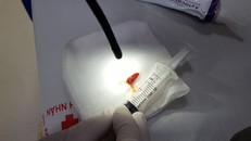 Mảnh ớt được các bác sĩ gắp khỏi phế quản bệnh nhân.