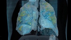 Hình ảnh thực tế ảo lá phổi nhiễm nCoV