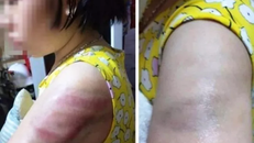 Đánh học sinh bầm tím tay, cô giáo bị đình chỉ hết năm học