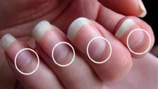 Hình dạng liềm móng tay tiết lộ điều gì về vấn đề sức khỏe?
