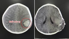 Hình ảnh trước và sau phẫu thuật lấy máu tụ nội sọ cho bé