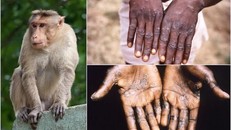 WHO khuyến cáo về bệnh đậu mùa khỉ - thường thấy ở Trung Phi và Tây Phi