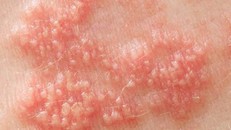 Nghiên cứu về nguồn gốc căn bệnh viêm da phổ biến do nhiễm virus herpes