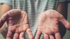 Việt Nam cần chuẩn bị các phương án sẵn sàng ứng phó khi bệnh đậu mùa khỉ xâm nhập