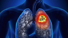 Khoảng 15% bệnh nhân phát hiện ung thư phổi ở VN còn sống sau 5 năm