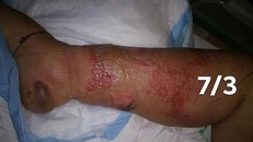 Suýt mất cả chân vì thói quen làm móng tại tiệm