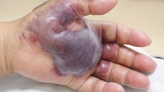 Nhiễm khuẩn do ăn sushi, người đàn ông 71 phải cưa tay vì hoại tử