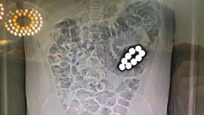 Vụ học sinh nuốt 9 viên bi tại Bình Dương: Nhà trường lên tiếng, lộ tình tiết bất ngờ