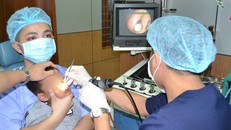 Viên bi nhựa nằm sâu trong hốc mũi của bé trai 4 tuổi