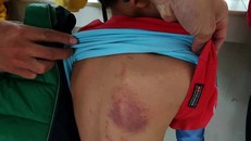 Xử phạt 5 triệu đồng cô giáo đánh học sinh bầm lưng