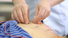 Các bệnh nhân được sử dụng phương pháp Điện châm tại Bệnh viện Y học cổ truyền tỉnh Lạng Sơn. 