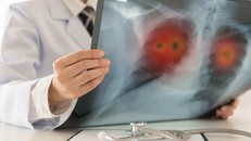 Giải mã lý do ung thư thường di căn đến phổi