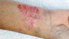 Nhiễm nấm có thể dẫn đến nguy cơ tử vong cao