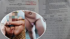 Biên bản làm việc được gia đình bệnh nhân cho là bị cắt ghép và hình ảnh bé trai phẩu thuật phải khâu nhiều mũi. 