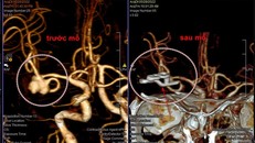 Bệnh viện Nguyễn Tri Phương: Phẫu thuật não, hồi sinh bệnh nhi mắc động kinh kháng trị.
