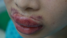 Môi sưng to như quả cà chua vì biến chứng sau tiêm filler không rõ nguồn gốc