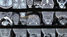 Bác sĩ khuyến cáo, cha mẹ tránh cho bé cầm những vật nhọn như đũa, bút chạy chơi để tránh xảy ra tai nạn đáng tiếc.