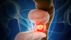 Khám phá mới hé lộ cơ chế hình thành ung thư tuyến tiền liệt