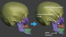 Điều trị móm do xương hàm