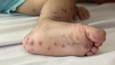 TP HCM ghi nhận 3 ca tử vong do tay chân miệng đầu tiên năm 2026​