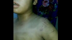 Các vết thương trên người bé N.