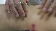 Vết đạn trên cơ thể một nạn nhân