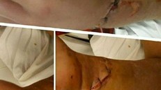 Cánh tay phải của cháu Hùng bị đứt lìa phải nối 26 gân tay